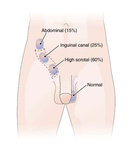 Undescended testes are the most common male birth defect, occurring in 3 percent of infant boys.