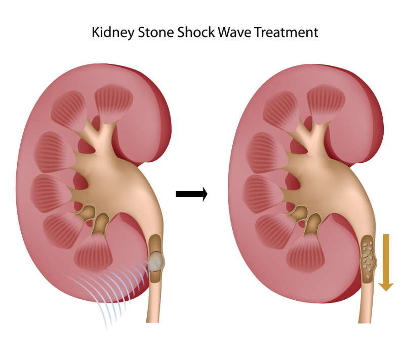 Shock wave treatment, also known as lithotripsy, can help break up kidney stones into smaller pieces, allowing them to pass out of the body in the urine stream.