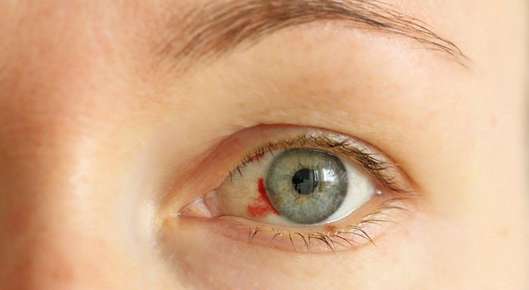 Image of an occlusion causing redness in eyes.