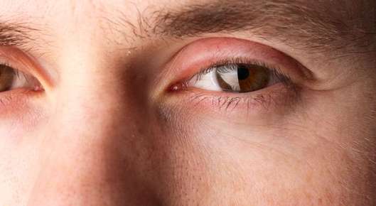 Close up image of swollen eyelids.