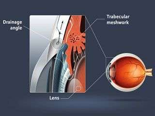 Cartoon image of glaucoma.