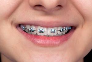 Teenage girl with braces