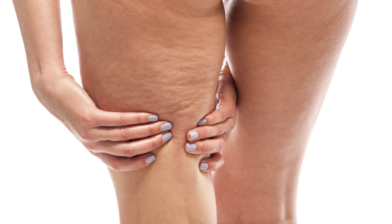 cellulite on back of thighs