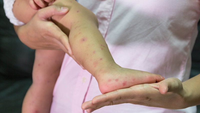 rash on child's leg
