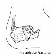 Calcan Fractures 1 Calcan Fractures 1
