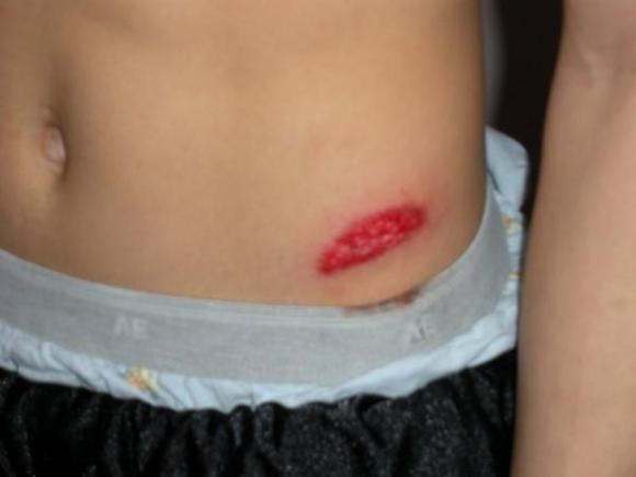More rash