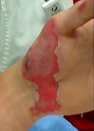 left hand few days later