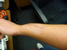 Healed arm
