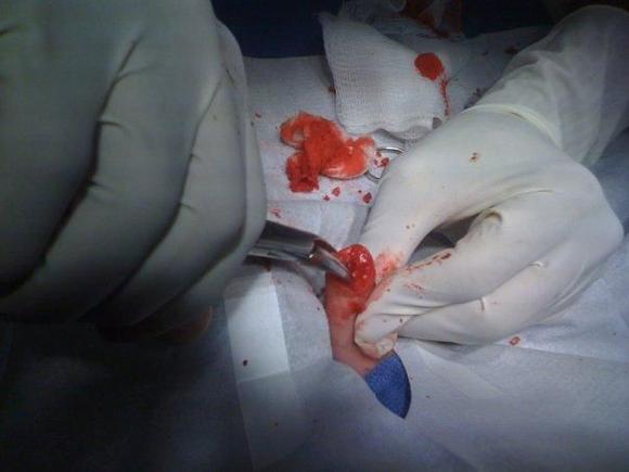 finger 1