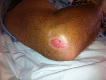 The only road rash I recieved