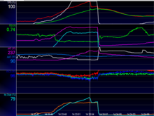 ICT in boost.  Cursor in boost region.  Pre-boost was apx 15 minute cruise in stop and go.