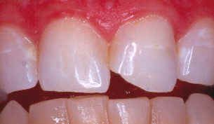 Chipped_Tooth_Before_1.jpg