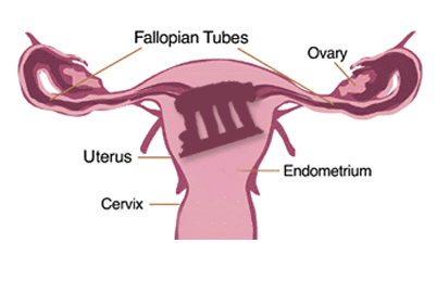 manifoldectomy.gif